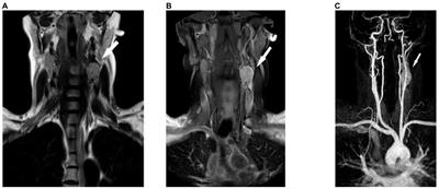 Preoperative percutaneous Onyx embolization of carotid body paragangliomas with balloon test occlusion